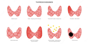 THYROID POSTER SMALL